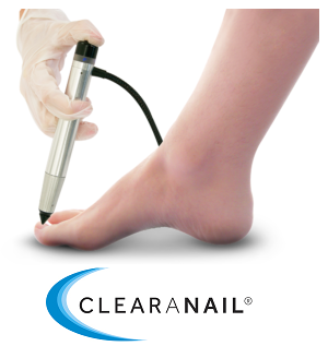 belleville foot doctor for toenail fungus treatment